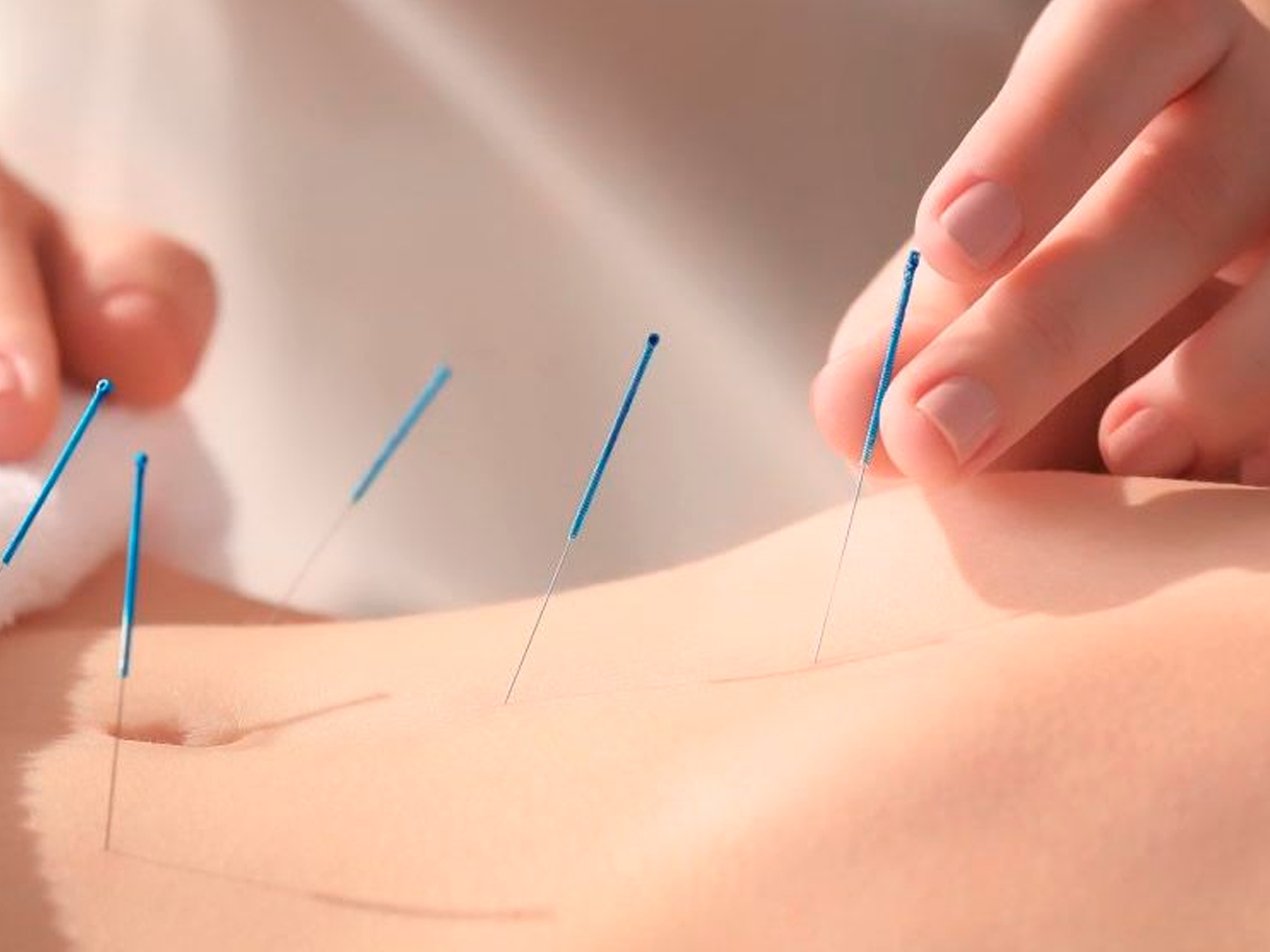 agujas de acupuntura